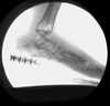 An x-ray of a shod foot phantom acquired with single-plane system