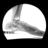 An X-ray of a shod foot captured by a fluoroscopy system.